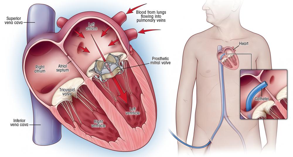 what-is-the-leaking-heart-valve-life-expectancy